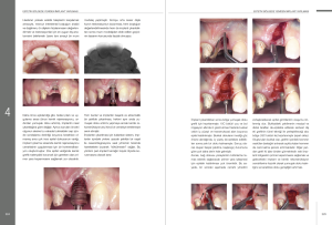İmplant Çevresi Estetik Mukogingival Cerrahi