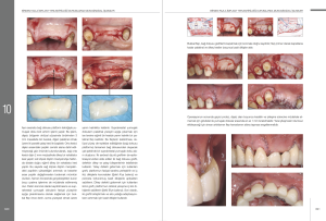 İmplant Çevresi Estetik Mukogingival Cerrahi