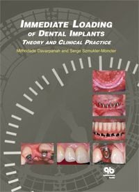 Immediate Loading of Dental Implants: Theory and Clinical Practice