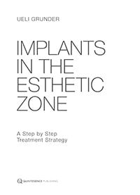 Implants in the Esthetic Zone: A Step-by-Step Treatment Strategy