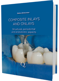 Composite Inlays and Onlays