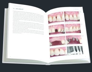 Estetik bölgede implant uygulamaları-Adım adım tedavi stratejileri