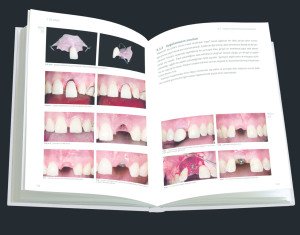 Estetik bölgede implant uygulamaları-Adım adım tedavi stratejileri