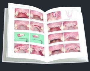 Estetik bölgede implant uygulamaları-Adım adım tedavi stratejileri