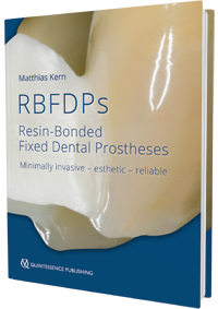 Resin-Bonded Fixed Dental Prostheses
