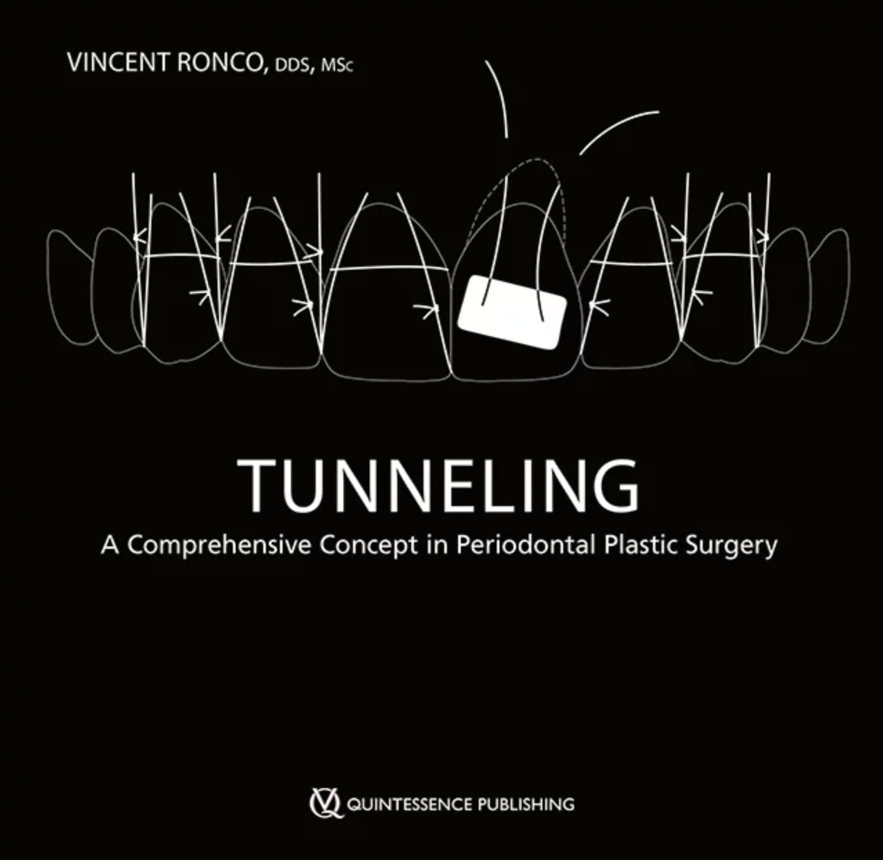 Tunneling - A Comprehensive Concept in Periodontal Plastic Surgery