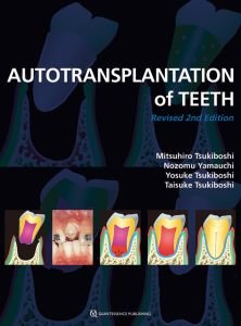 Autotransplantation of Teeth