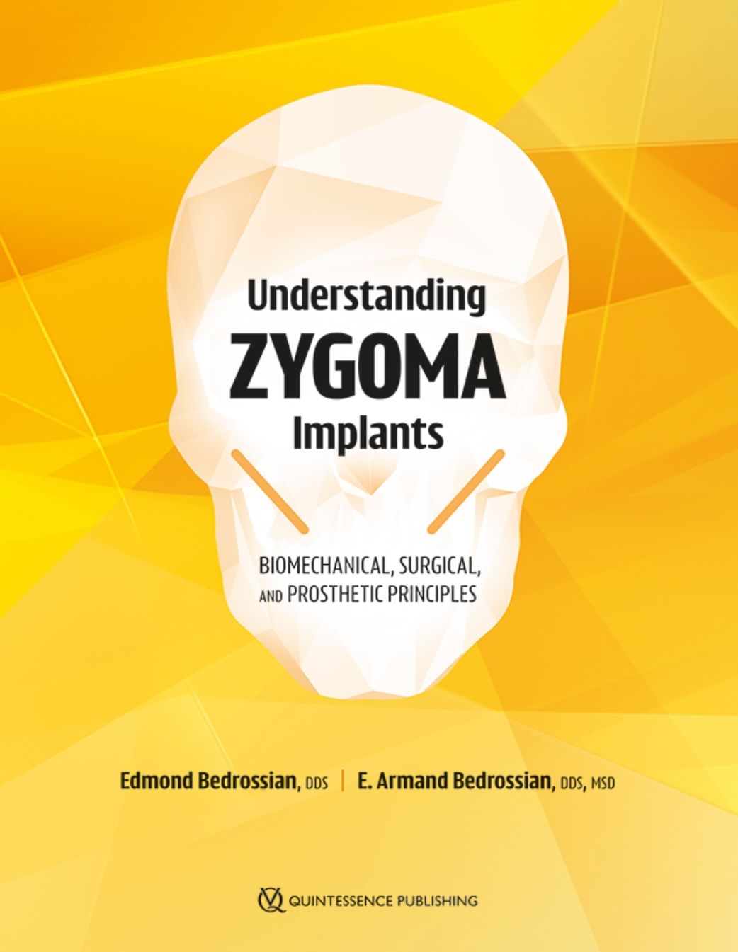 Understanding Zygoma Implants Biomechanical, Surgical, and Prosthetic Principles