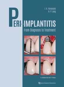 Peri-Implantitis From Diagnosis to Treatment