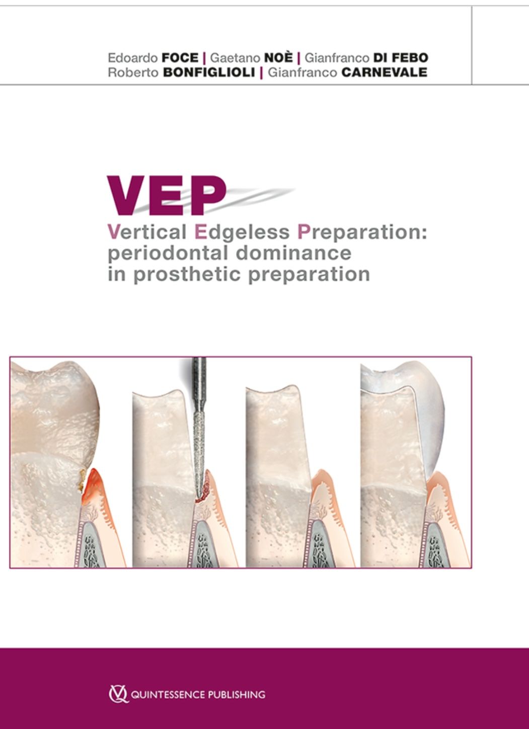 VEP Vertical Edgeless Preparation Periodontal dominance in prosthetic preparation
