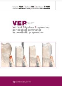 VEP Vertical Edgeless Preparation Periodontal dominance in prosthetic preparation
