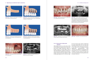 İmplantolojide Kemik ve Yumuşak Doku Ogmentasyonu