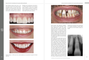 İmplant Çevresi Estetik Mukogingival Cerrahi