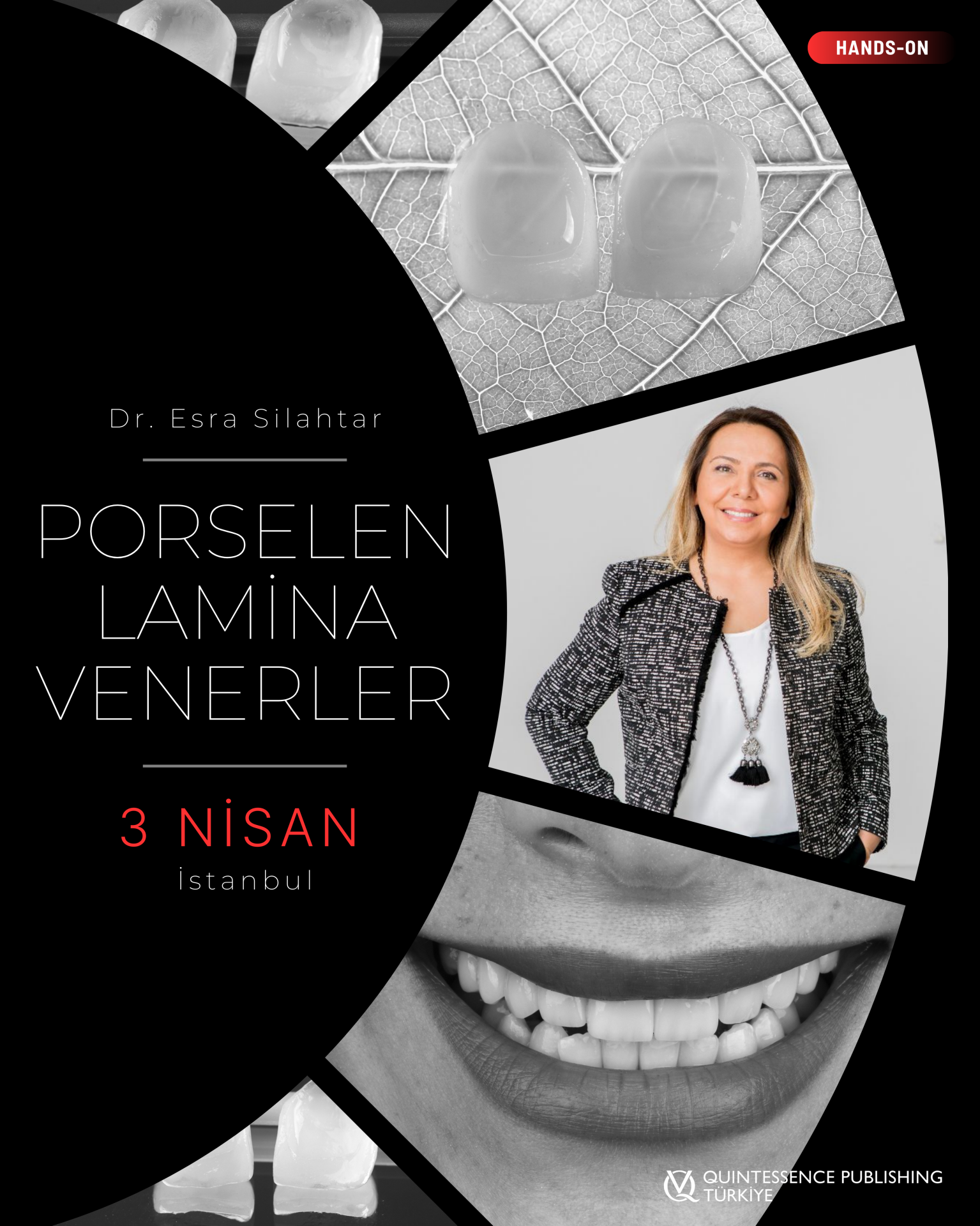 Porselen Lamina Venerler - 3 Nisan 2026