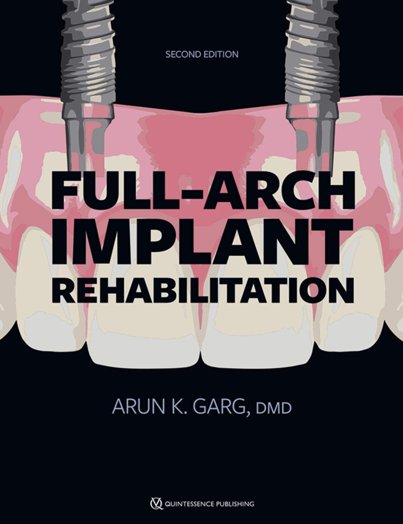 Full-Arch Implant Rehabilitation