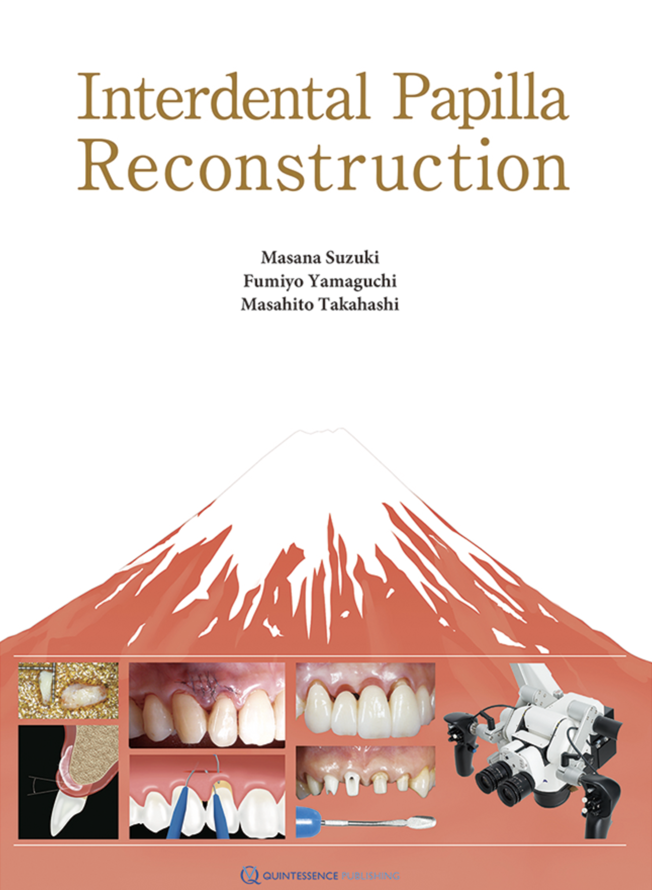 Interdental Papilla Reconstruction